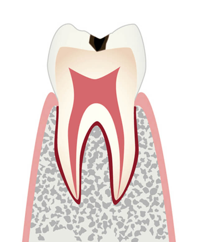 C1：エナメル質に小さな穴が空いたむし歯