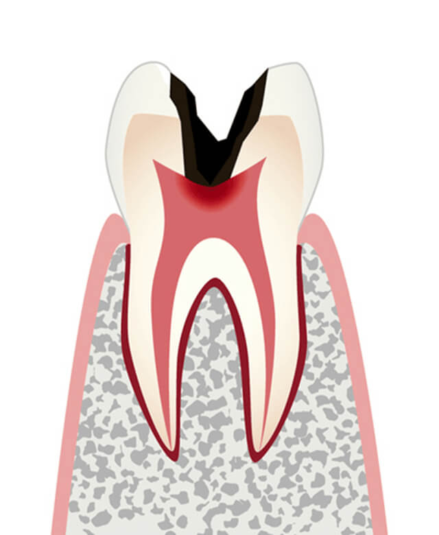 C3：神経まで進行したむし歯