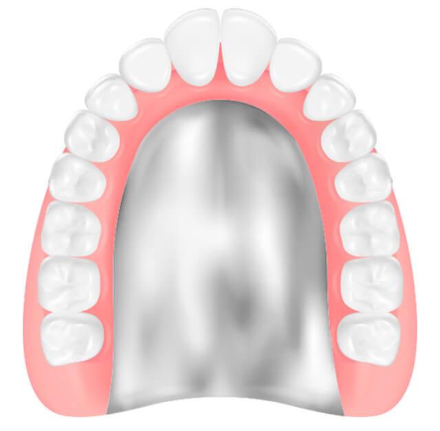 チタン床義歯
