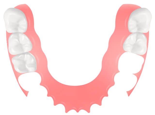 ノンクラスプデンチャー width=